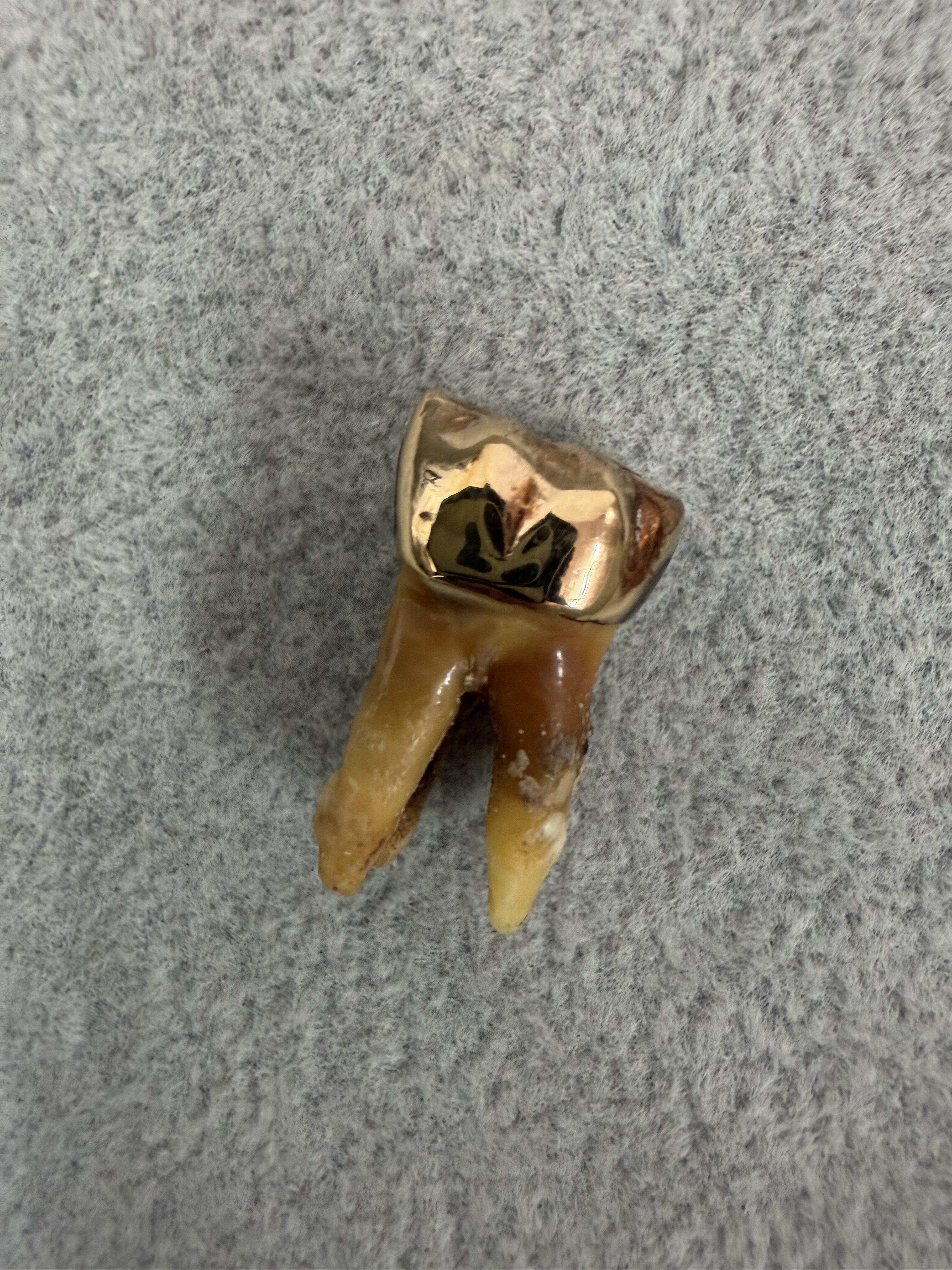 【買取実績：青山店】金歯